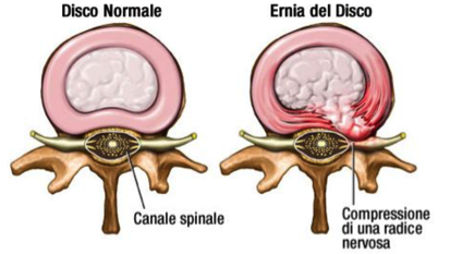 Ernia del disco