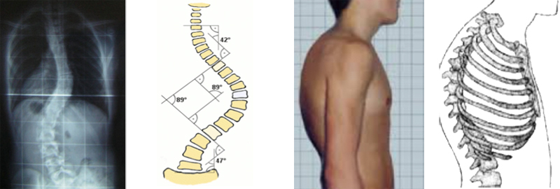 Cosa è la Scoliosi?